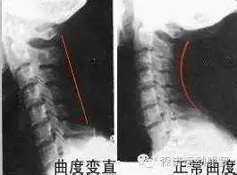 颈椎病怎么治疗好？ 治疗颈椎病最好的方法是什么？-2.jpg