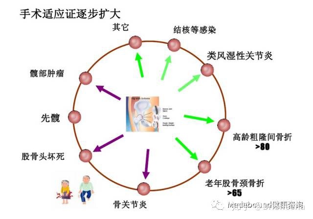 股骨头坏死能治疗吗？-4.jpg