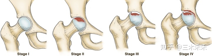 股骨头坏死能治疗吗？-3.jpg