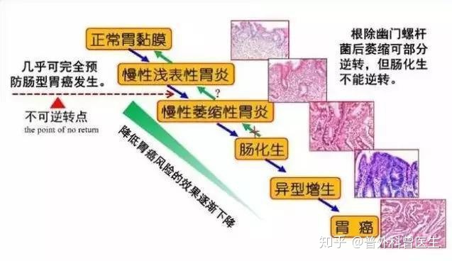 浅表性胃炎距离胃癌有多远？应该怎么治疗？-3.jpg