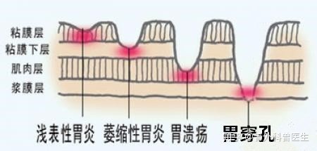 浅表性胃炎距离胃癌有多远？应该怎么治疗？-2.jpg